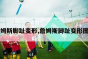 詹姆斯脚趾变形,詹姆斯脚趾变形图片